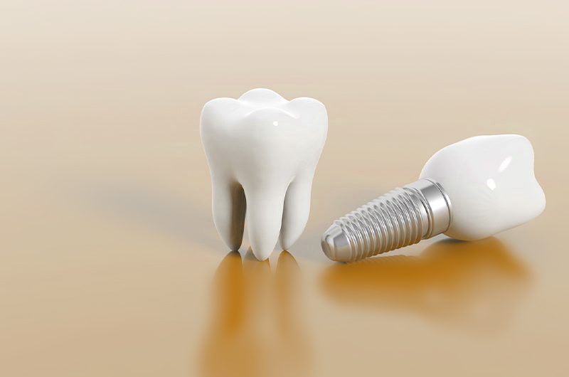 人工歯根を顎の骨に埋め込むインプラント治療のイメージ