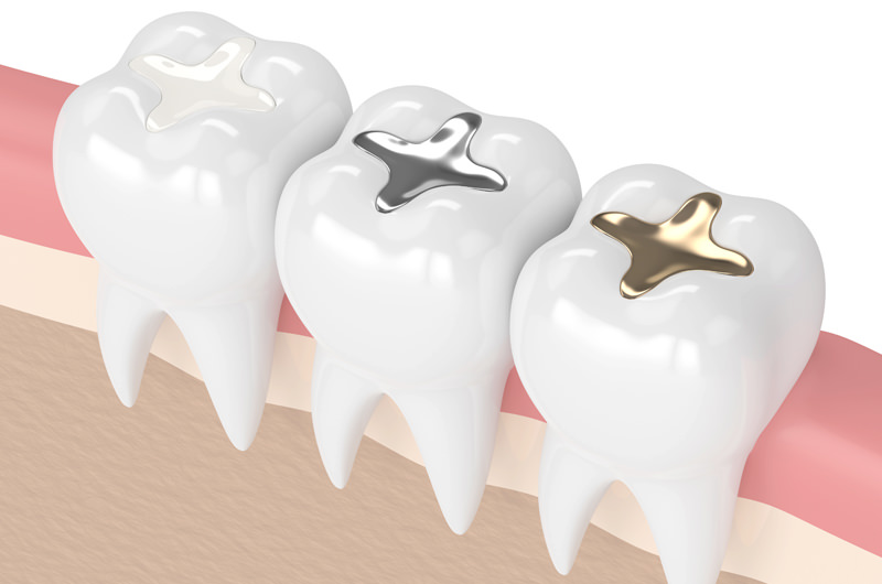 詰め物・被せ物とは？失った歯を補う治療について