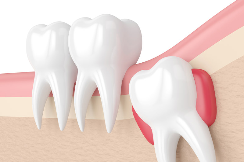 親知らずの生え方を確認しながら行う歯科口腔外科の診察