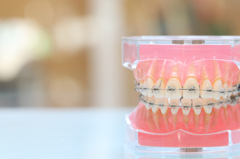 矯正治療を始めるタイミングと適切な年齢