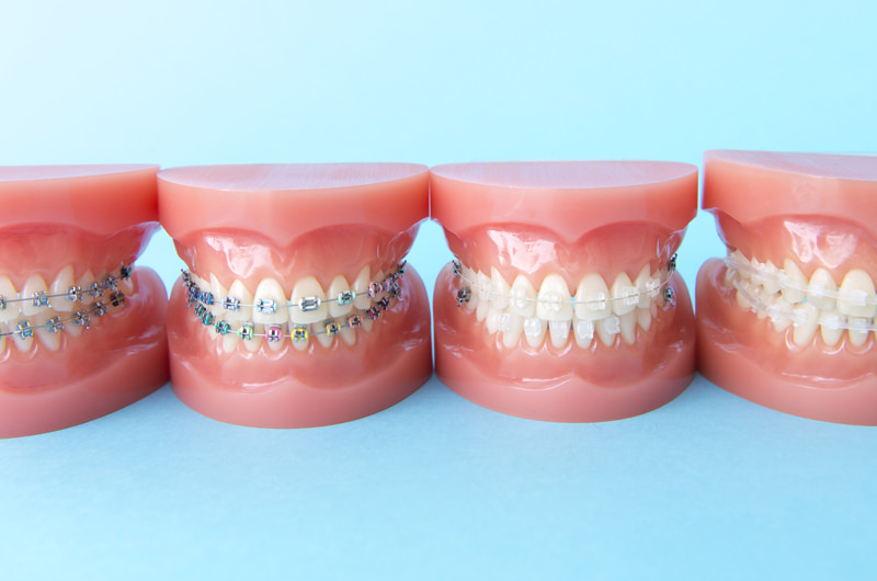 ワイヤー矯正の特徴