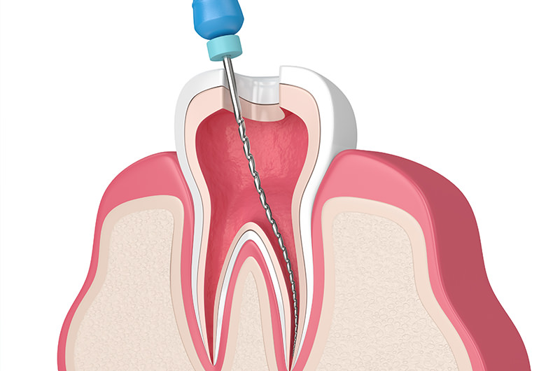 根管治療が必要となる主な症状